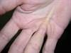 Derm Dx: A growing knot in the palm Derm Dx: A growing knot in the palm