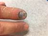 Ortho Dx: Would you remove this fingernail? Ortho Dx: Would you remove this fingernail?