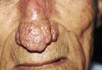 Photosensitivity diseases: a review of sun-exposed skin rashes Photosensitivity diseases: a review of sun-exposed skin rashes