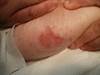 Derm Dx: Discolored patches on the torso of a woman with vulvar lichen sclerosus Derm Dx: Discolored patches on the torso of a woman with vulvar lichen sclerosus