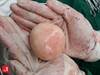 Image of the Week: Free-floating mass found in stab victim Image of the Week: Free-floating mass found in stab victim