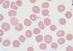 Case Study: Fever, Low Platelets and Right-Sided Abdominal Pain Case Study: Fever, Low Platelets and Right-Sided Abdominal Pain