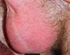Derm Dx: A reddish rash on the scrotum Derm Dx: A reddish rash on the scrotum