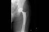 Ortho Dx: Thigh pain 2 years after hip replacement surgery Ortho Dx: Thigh pain 2 years after hip replacement surgery