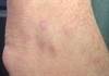 Derm Dx: A factory worker with an itchy rash on the wrists and ankles Derm Dx: A factory worker with an itchy rash on the wrists and ankles