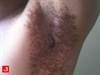 Image of the Week: What's causing this greasy underarm rash? Image of the Week: What's causing this greasy underarm rash?