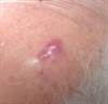 Derm Dx: Simultaneous appearance of multiple indurated plaques Derm Dx: Simultaneous appearance of multiple indurated plaques