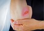 Stat consult: Minor burns Stat consult: Minor burns