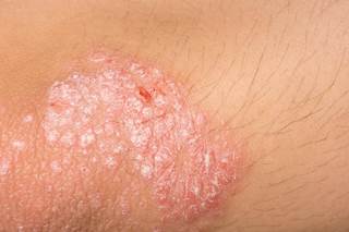 The most common comorbidities found in patients with psoriasis are hyperlipidemia, hypertension, depression, type 2 diabetes mellitus, and obesity. The most common comorbidities found in patients with psoriasis are hyperlipidemia, hypertension, depression, type 2 diabetes mellitus, and obesity.