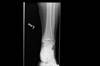 Ortho Dx: Ankle stabilization Ortho Dx: Ankle stabilization