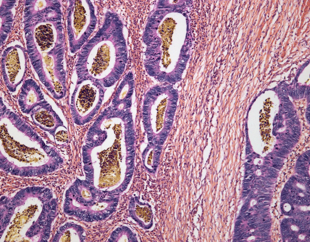 increased-adenoma-detection-rate-associated-with-lower-risk-of