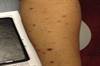 Derm Dx: A pruritic eruption on the arms and trunk Derm Dx: A pruritic eruption on the arms and trunk