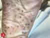 Image of the Week: What is the cause of this pustular rash? Image of the Week: What is the cause of this pustular rash?