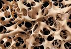 Early antiretroviral therapy initiation linked to bone loss in HIV patients Early antiretroviral therapy initiation linked to bone loss in HIV patients