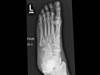Ortho Dx: Pain over the lateral midfoot Ortho Dx: Pain over the lateral midfoot