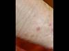 Derm Dx: Bumps on the leg 10 years after cancer surgery Derm Dx: Bumps on the leg 10 years after cancer surgery