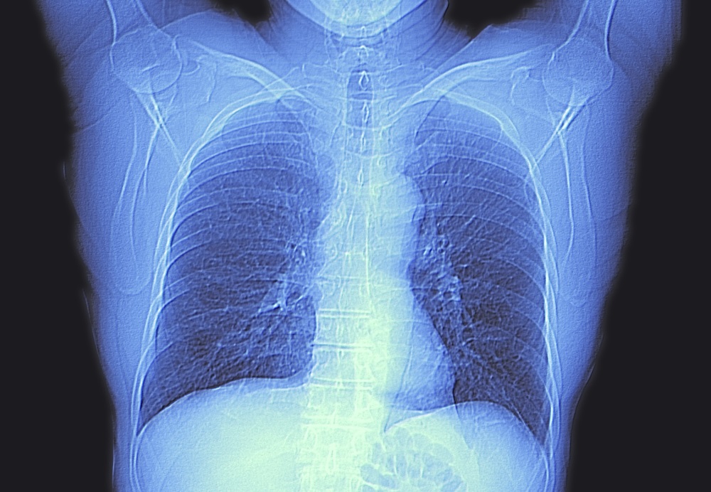 Chest CT provides additional insight in COPD assessment - The Clinical