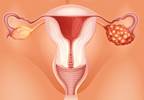 Multimodal Ovarian Cancer Screening May Be Cost-Effective in the United States Multimodal Ovarian Cancer Screening May Be Cost-Effective in the United States