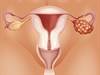 Higher Levels of Anti-CA15.3 and Anti-CA125 Linked to Increased Risk for Mucinous Epithelial Ovarian Cancer Higher Levels of Anti-CA15.3 and Anti-CA125 Linked to Increased Risk for Mucinous Epithelial Ovarian Cancer