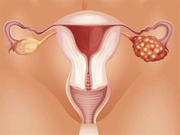 Higher Levels of Anti-CA15.3 and Anti-CA125 Linked to Increased Risk for Mucinous Epithelial Ovarian Cancer Higher Levels of Anti-CA15.3 and Anti-CA125 Linked to Increased Risk for Mucinous Epithelial Ovarian Cancer