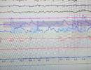 SomnaPatch Effective in Diagnosing Obstructive Sleep Apnea SomnaPatch Effective in Diagnosing Obstructive Sleep Apnea