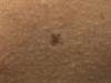 Derm Dx: Multiple moles and extensive sun exposure Derm Dx: Multiple moles and extensive sun exposure