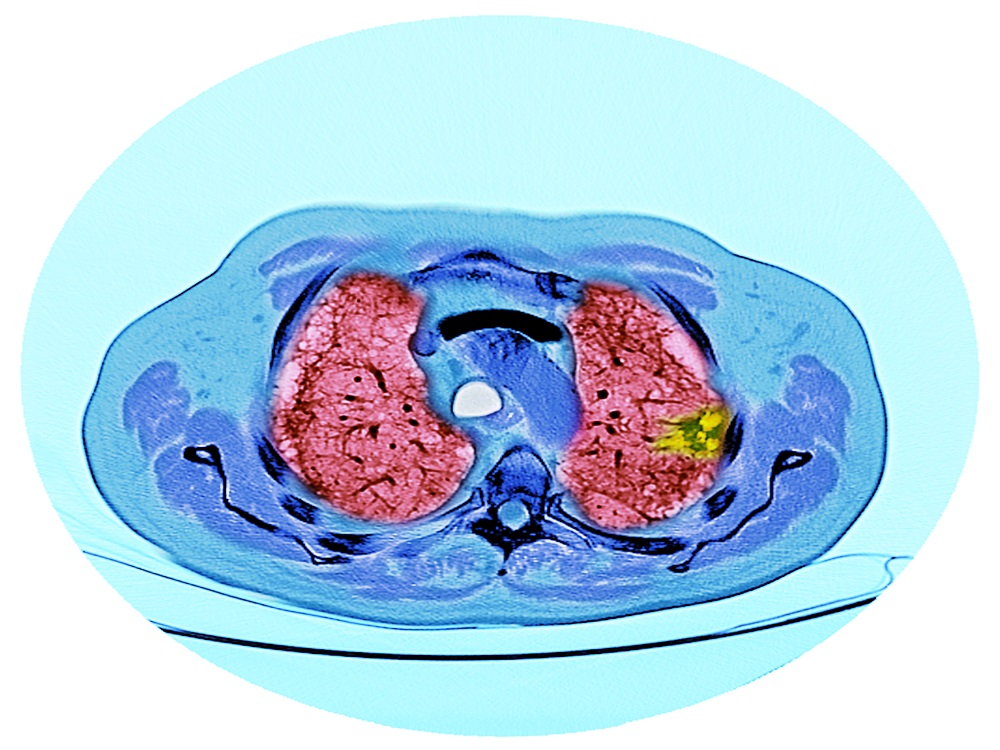 after-nsclc-resection-no-benefit-to-more-frequent-surveillance