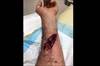 Ortho Dx: A chainsaw injury to the forearm Ortho Dx: A chainsaw injury to the forearm