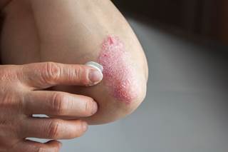 Former smokers had a significantly higher risk for developing psoriasis. Former smokers had a significantly higher risk for developing psoriasis.