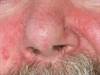 Derm Dx: A rash on the nasolabial folds, eyelashes, and scalp Derm Dx: A rash on the nasolabial folds, eyelashes, and scalp