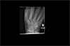 Ortho Dx: Wrist pain after a motorcycle accident Ortho Dx: Wrist pain after a motorcycle accident