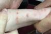Derm Dx: Pink to flesh-colored papules on a young child Derm Dx: Pink to flesh-colored papules on a young child
