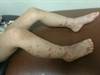 Image of the Week: Abdominal pain, a rash, and knee pain Image of the Week: Abdominal pain, a rash, and knee pain