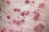 Hand-foot-and-mouth disease in adults Hand-foot-and-mouth disease in adults
