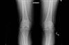 Ortho Dx: Which grade of arthritis does this patient have? Ortho Dx: Which grade of arthritis does this patient have?
