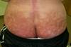 Derm Dx: Discoloration on the buttocks and lower back Derm Dx: Discoloration on the buttocks and lower back