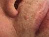 Derm Dx: A flesh-colored lesion above the lip Derm Dx: A flesh-colored lesion above the lip
