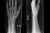 Ortho Dx: Treatment for a comminuted scaphoid fracture Ortho Dx: Treatment for a comminuted scaphoid fracture