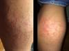 Derm Dx: A red and itchy rash after a vacation Derm Dx: A red and itchy rash after a vacation