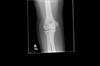Ortho Dx: Elbow pain in the throwing athlete Ortho Dx: Elbow pain in the throwing athlete