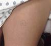 Derm Dx: A hard, fixed nodule with a bluish tint on the leg Derm Dx: A hard, fixed nodule with a bluish tint on the leg