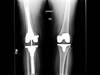 Ortho Dx: Complications after total knee arthroplasty Ortho Dx: Complications after total knee arthroplasty