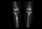 Post-Parathyroidectomy Predictors of Hungry Bone Syndrome Identified Post-Parathyroidectomy Predictors of Hungry Bone Syndrome Identified