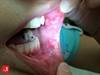 Image of the Week: What is causing this patient's aphthous ulcers and abdominal tenderness? Image of the Week: What is causing this patient's aphthous ulcers and abdominal tenderness?