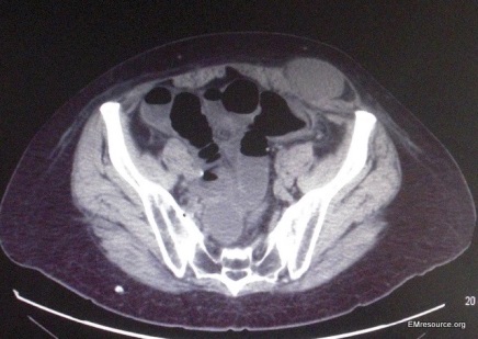 Case Study: Abdominal pain, distention, and constipation - The Clinical