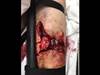 Ortho Dx: Preventing postoperative infection after an open femur fracture Ortho Dx: Preventing postoperative infection after an open femur fracture