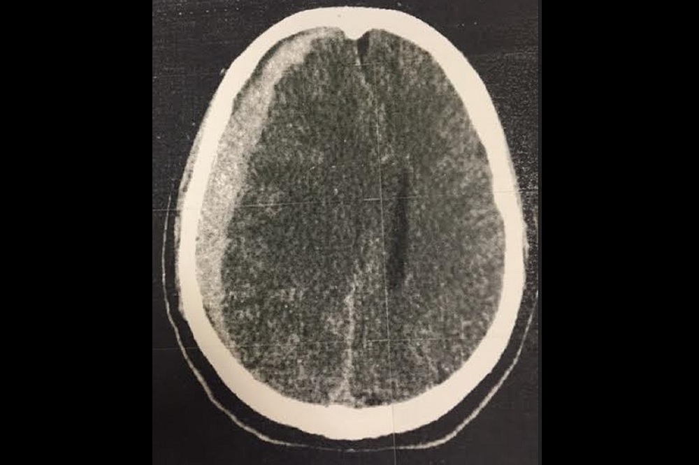 How Long Is Recovery From Subdural Hematoma