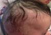 Derm Dx: Scaling dermatitis on the scalp and face Derm Dx: Scaling dermatitis on the scalp and face