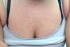 Derm Dx: A rash after a streptococcal throat infection Derm Dx: A rash after a streptococcal throat infection