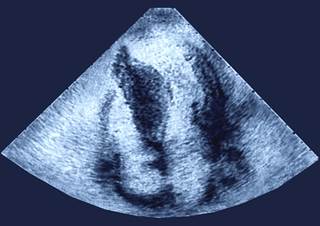 Hypertrophy of the cardiac interventricular septum. Hypertrophy of the cardiac interventricular septum.
